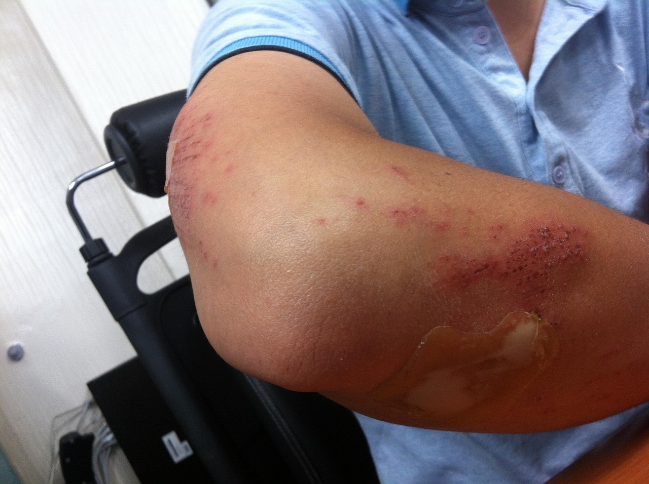 Wound Bed Preparation and Maintenance